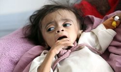 Yemen'de yetersiz beslenen çocuklar kısıtlı imkânlarla hayata tutunmaya çalışıyor