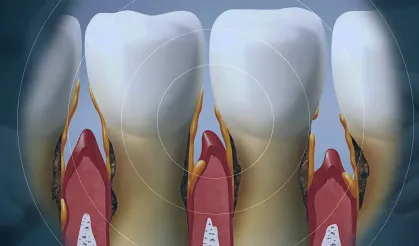 Diş eti çekiliyorsa kemik de eriyordur!