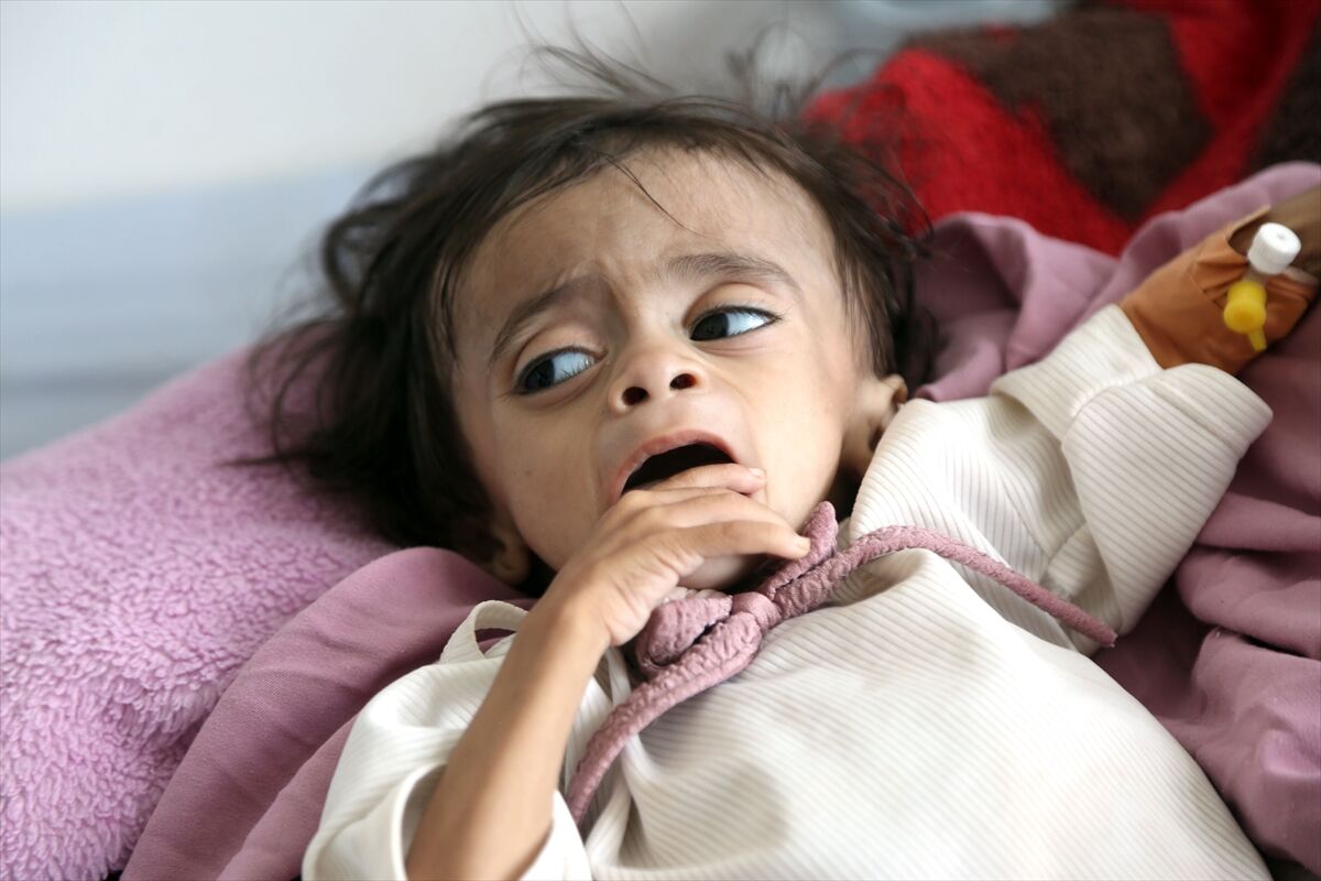 Yemen'de yetersiz beslenen çocuklar kısıtlı imkânlarla hayata tutunmaya çalışıyor